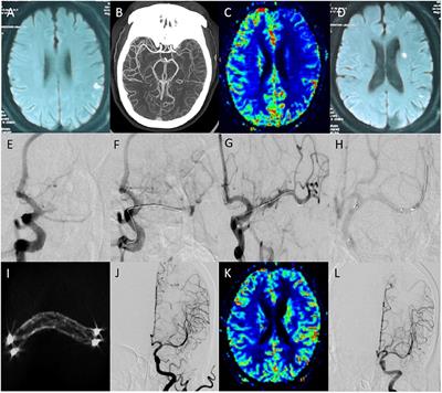 Clinical study on endovascular recanalization of non-acute symptomatic middle cerebral artery occlusion